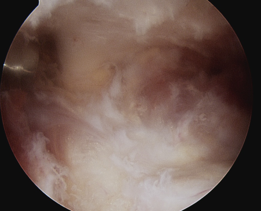 Shoulder Subacromial Space Spinous Process